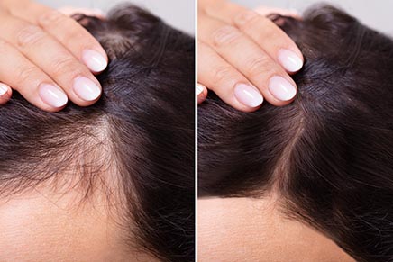 REVIVE MESOTHERAPY Hair Loss  Revive Clinic